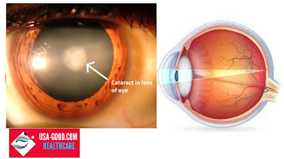 What is Lens of The Eye