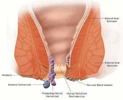 Pregnancy and Hemorrhoids