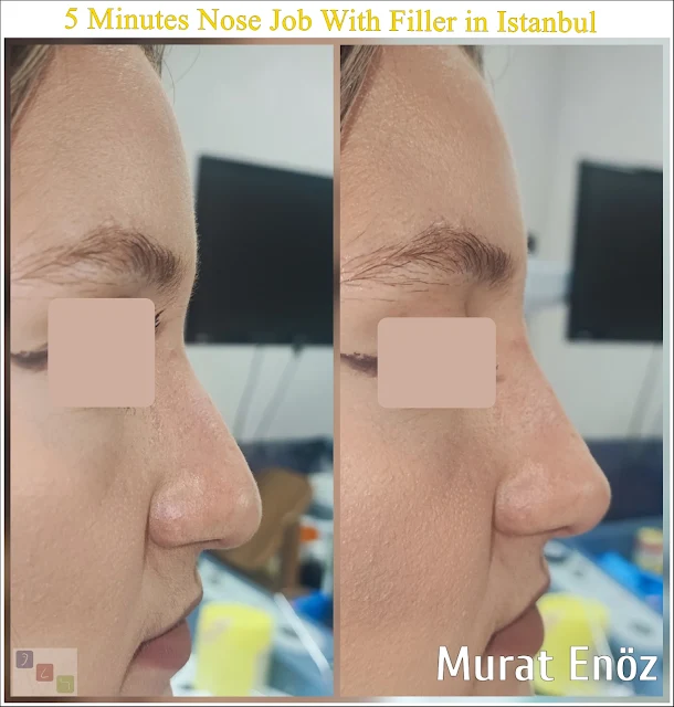 Istanbul non-surgical nose job,dermal filler experts,filler procedure Turkey,nasal enhancement,filler nose job.,non-invasive rhinoplasty,Istanbul aesthetic clinic,