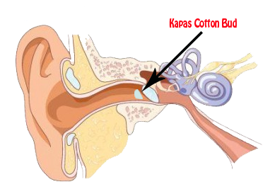 Kapas Cutton Bud yang tertinggal di dalam telingga