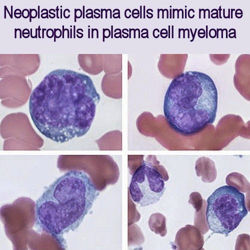 Medical Laboratory and Biomedical Science: Neoplastic plasma cells