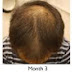 Propecia Finasteride make hair regrowth