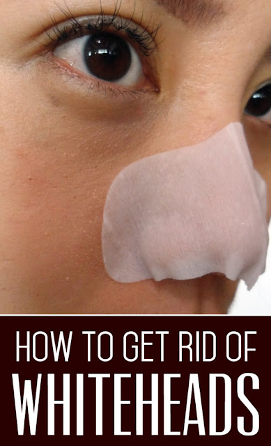 How to Get Rid of Whiteheads