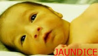 नवजात शिशु में जॉन्डिस (पीलिया) , JAUNDICE NEWBORN BOBY