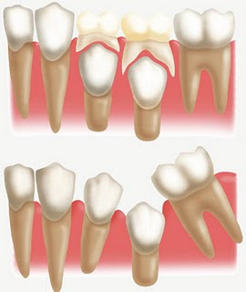 perda do dente de leite