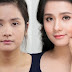 Phẫu thuật nâng gò má hết bao nhiêu tiền với công nghệ Hàn Quốc ?