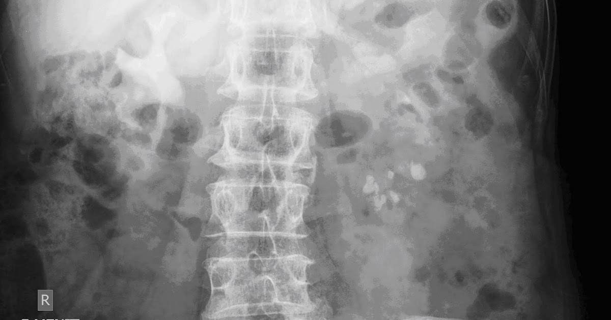 Dasar-Dasar Radiologi : Foto BNO-IVP ~ Catatan Dokter