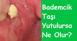 Bademcik Taşı Yutulursa Ne Olur