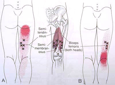 MIOTERAPIA