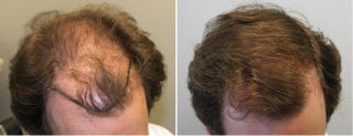 non-surgical hair loss treatment