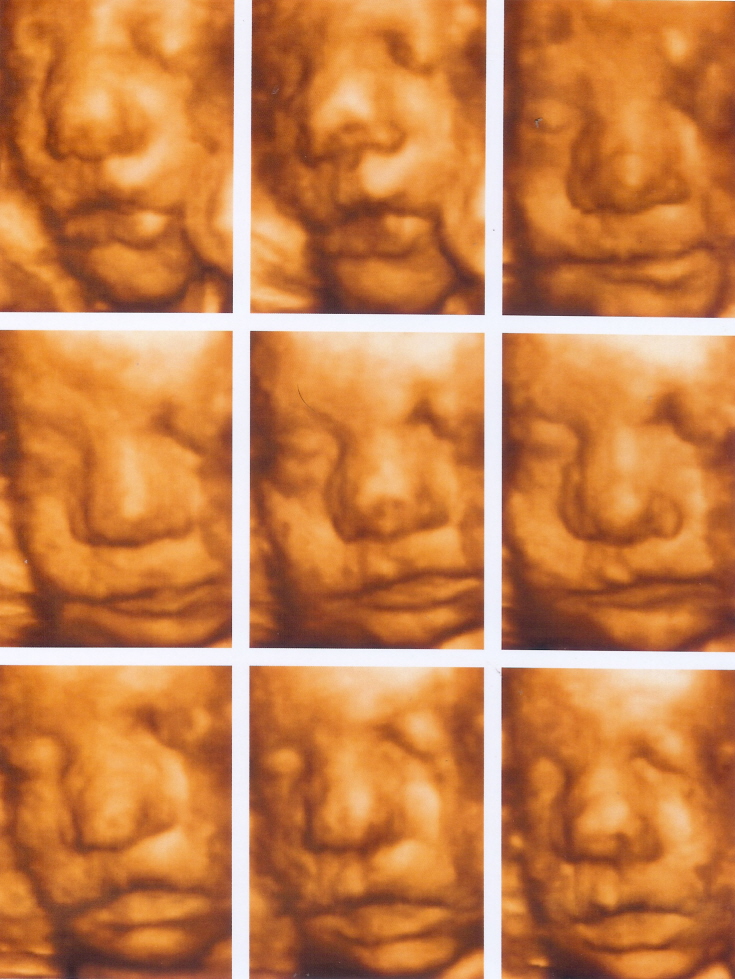 3d Ultrasound Pictures At 29 Weeks 3d Ultrasound Pictures At 29 Weeks