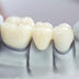 Bị móm răng có nên thực hiện bọc sứ?