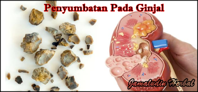 https://avinnetaherbal23.blogspot.com/2018/11/cara-alami-mengatasi-penyumbatan-pada.html