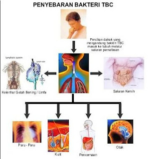 TBC atau Tuberkulosa