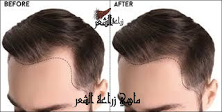 زراعة الشعر,عملية زراعة الشعر,زراعة الشعر في تركيا,طريقة زراعة الشعر,تكلفة زراعة الشعر,مراحل زراعة الشعر,زراعة الشعر تركيا,خطوات زراعة الشعر,تقنيات زراعة الشعر,طرق زراعة الشعر,زراعة,اضرار زراعة الشعر,نتائج زراعة الشعر,عمليات زراعة الشعر,جراحة زراعة الشعر,زرع الشعر,زراعة الشعر 2017,زراعة الشعر فى مصر,تجارب زراعة الشعر,كيفية زراعة الشعر,اجراء زراعة الشعر,أسعار زراعة الشعر,زراعة الشعر للنساء,تكلفة زراعة الشعر 2017,الشعر,بعد زراعة الشعر,زراعة الشعر dhi,زراعة الشعر fue,زراعة الشعر fut