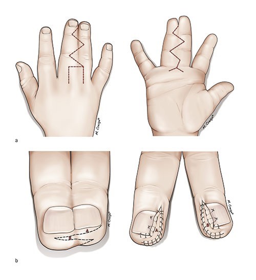 Syndactyly Disease: Causes, Types And Treatment Available