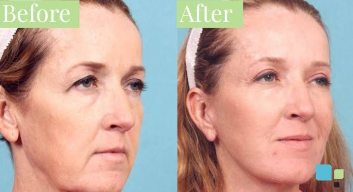 Blepharoplasty surgical procedure