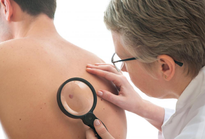 Diagnosing Skin Cancer