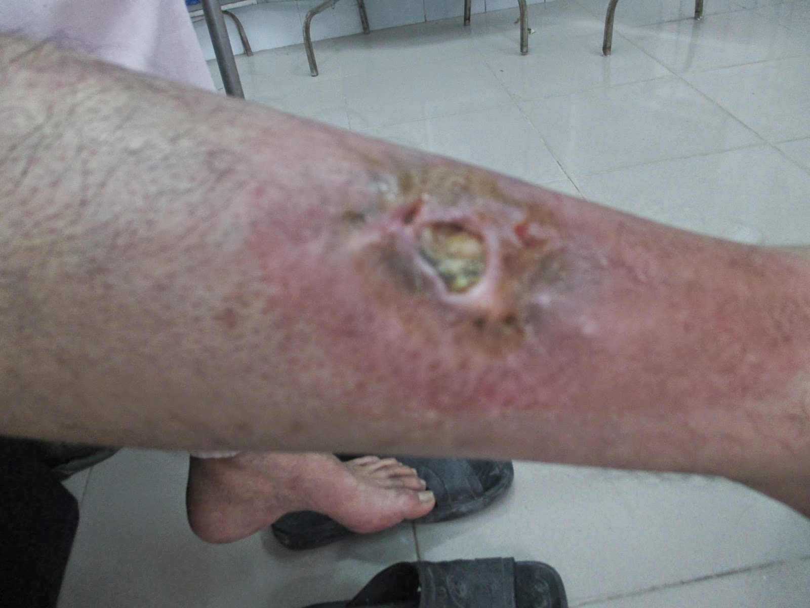 Rx in Vietnam 2014: Bullet Wound from "50" years ago