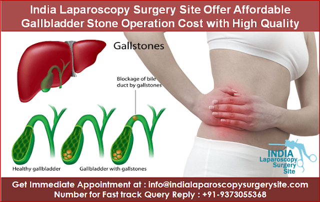 India Laparoscopy Surgery Site Offer Affordable Gallbladder Stone Operation Cost  with Quality