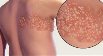 Home Remedies For Shingles