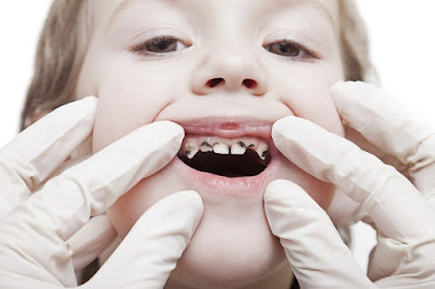 Vì sao nên phòng ngừa sâu răng cho trẻ