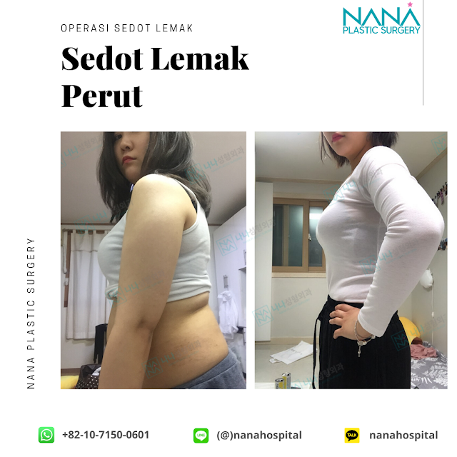 operasi plastik, operasi plastik korea, sedot lemak, sedot lemak badan, sedot lemak perut, sedot lemak lengan, sedot lemak paha, bedah plastik, berat badan ideal