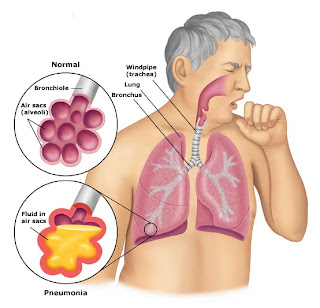 risk factors pneumonia