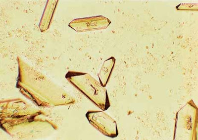 Triple phosphate crystals