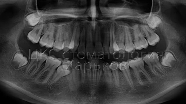 Панорамный снимок до ортодонтического лечения