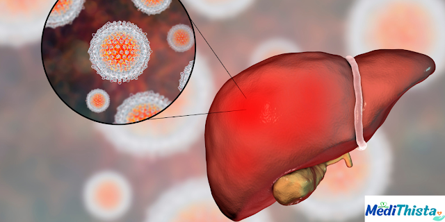 Understanding Hepatitis: Causes, Symptoms, and Treatment