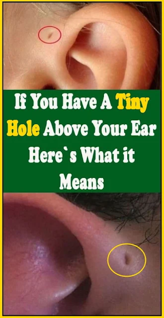 If You Have A Tiny Hole Above Your Ear, Here’s What It Means