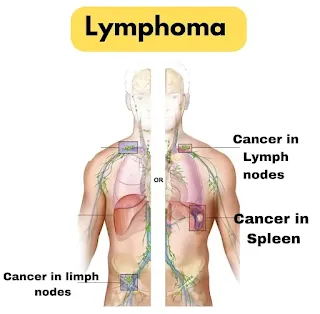 Lymphoma (Cancer)