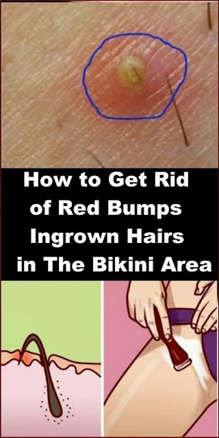 How To Get Rid Of Razor Bumps In The Bikini Area