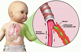 Bronchiolitis, The Bronchitis Version in Infant