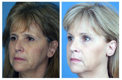 Temporal Brow Lift