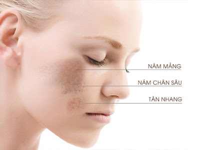 Cách chọn collagen trị nám da - SkinLift Collagen