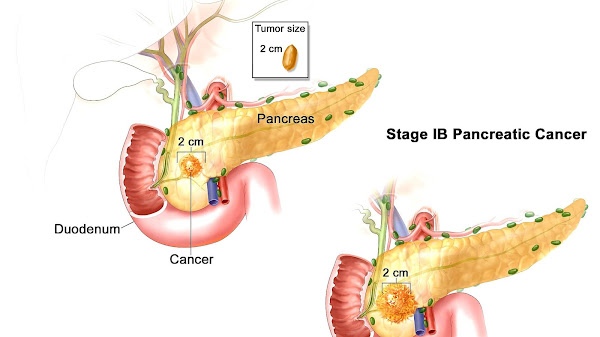 Alternative Pancreatic Cancer Treatments