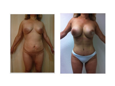 fotos antes y despues de una abdominoplastia lipectomia con aumento de busto guadalajara mexico