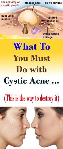 What To You Must Do with Cystic Acne