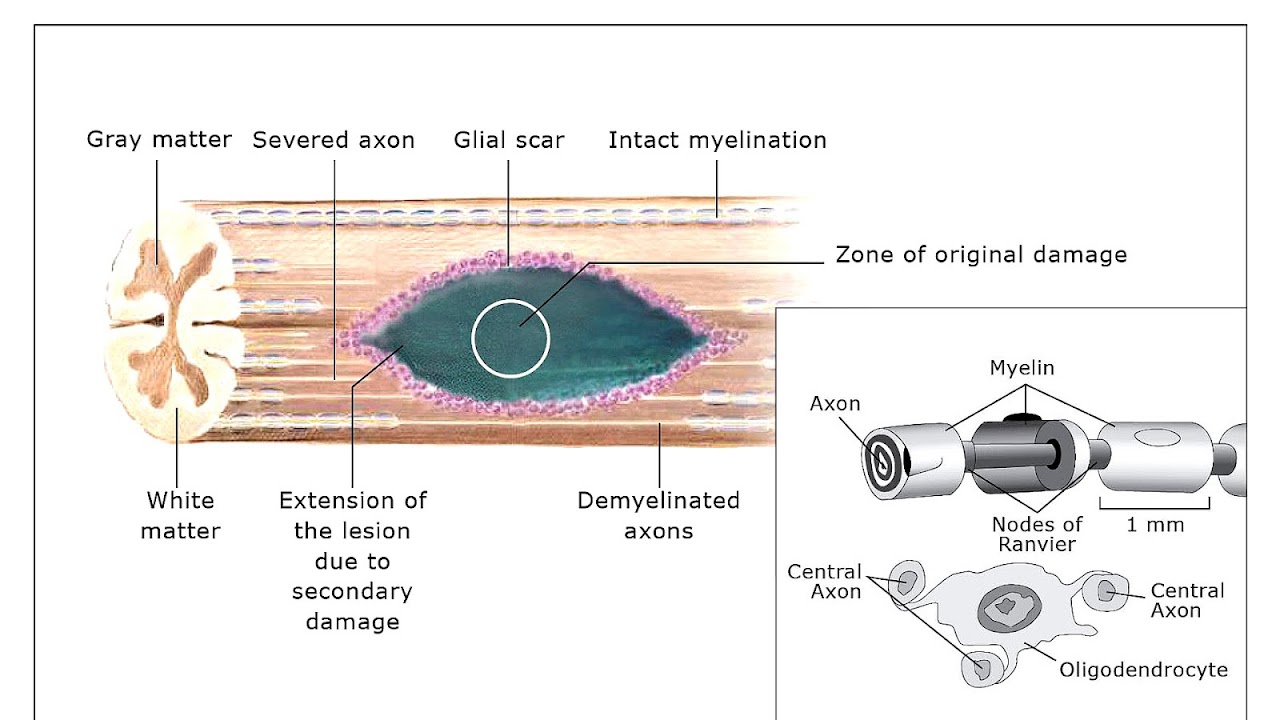 Stem Cell Therapy For Spinal Cord Injury