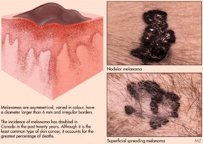 Skin Cancer And its Symptons