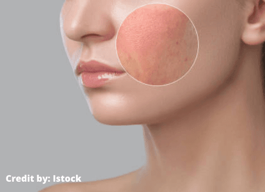 Best DIY Face Mask For Sensitive Skin
