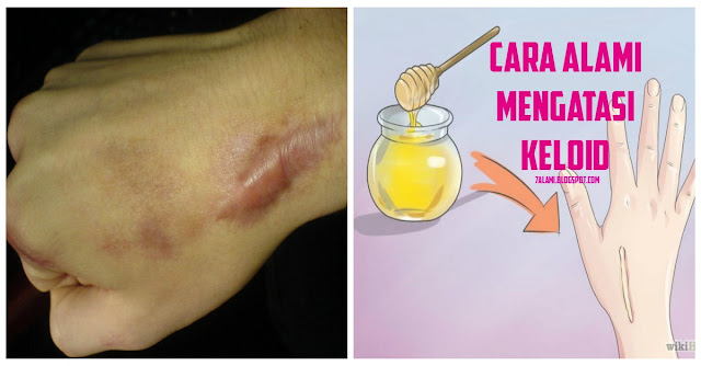 Ini Dia Aneka Cara Alami Menyingkirkan Keloid (Bekas Luka) yang
Menyebalkan!