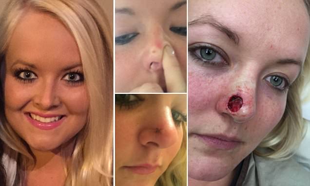 SHOCKING! Woman Goes To Tanning Salon For 11 Years, Gets Skin Cancer and A Hole On Her Nose!