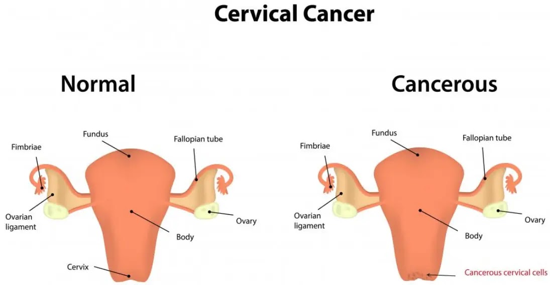 Life Expectancy of Stage 4 Cervical Cancer