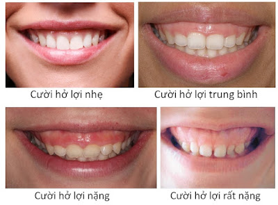 Cười hở lợi phải làm sao khắc phục-2