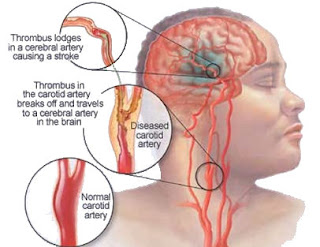 Cara Mencegah Penyakit Stroke