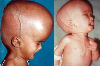 Bahaya Penumpukan Cairan Di Kepala Bayi