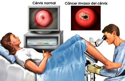 Imagen sobre Colposcopia a colores